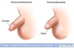 circumcision penis
